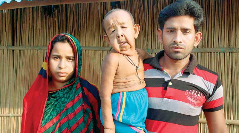 rare disease, 4 yrs child looks like 80 yrs