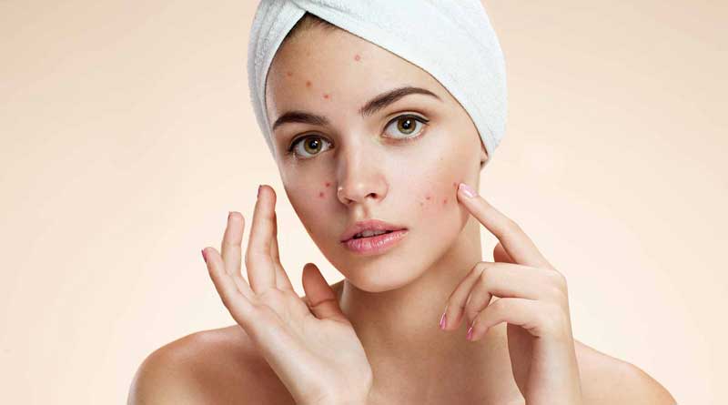 People With Acne Are Better Protected Against Ageing, Study Says