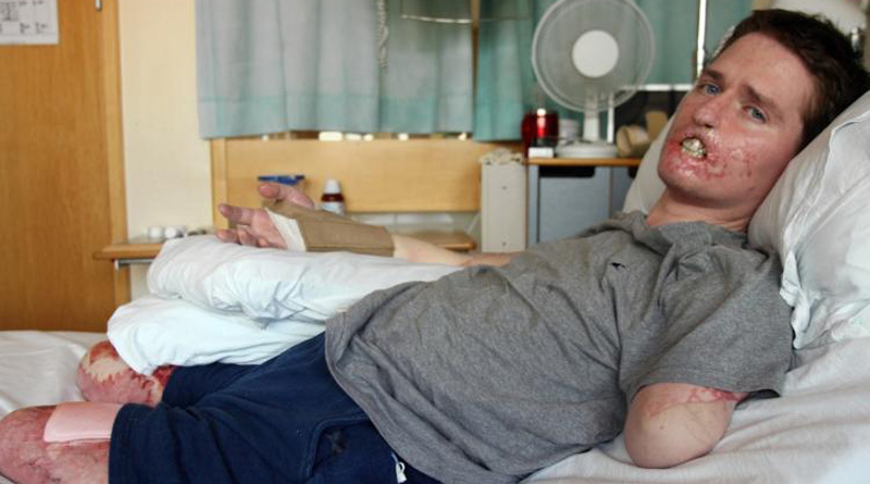 Horrific Flesh-Eating Bacteria That Killed Man In Four Days Expected To Rise