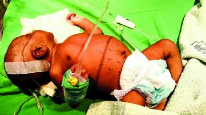 27-day-old baby girl of Odisha branded with hot iron for stomach ailment cure