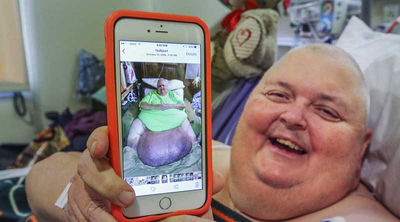 Tumor weighing 59 kg removed from Mississippi man’s stomach