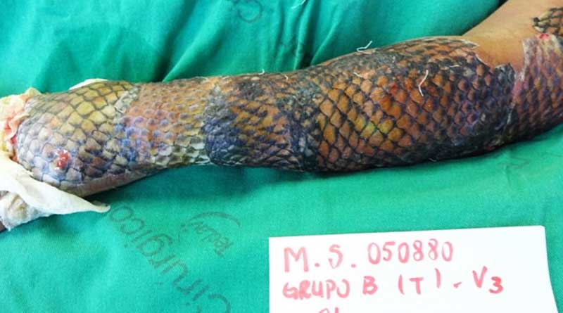 Brazil man uses Tilapia to heal burns