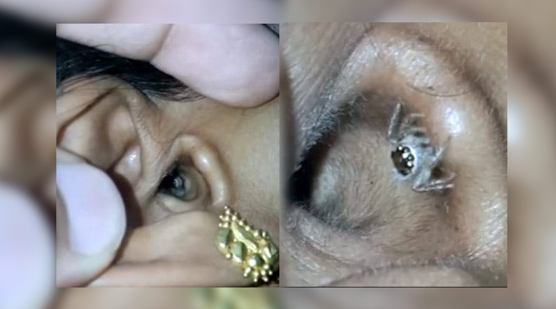 Video of Bengaluru woman extracting live spider from ear goes viral