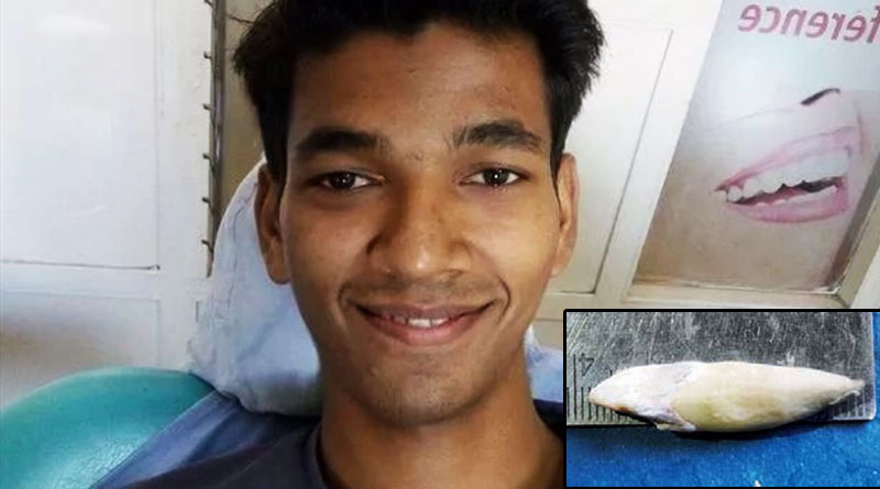 Indian boy punches way to Guinness record with longest tooth