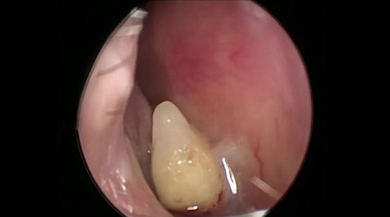 Woman grows tooth in nose, doctors puzzled