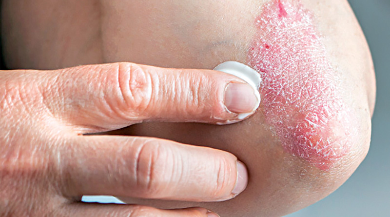 Psoriasis