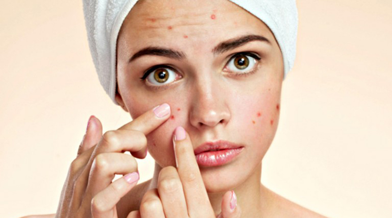 Acne 02_Web
