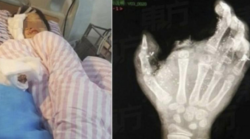 Mobile phone blast rips minor boy’s finger
