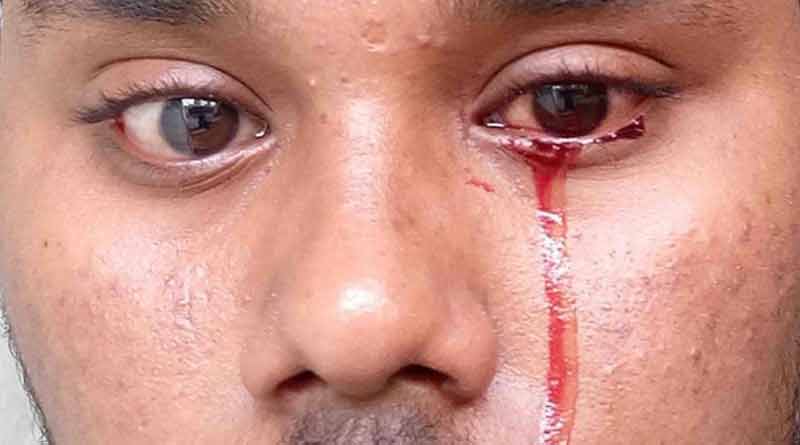 Man sheds bloody tears 