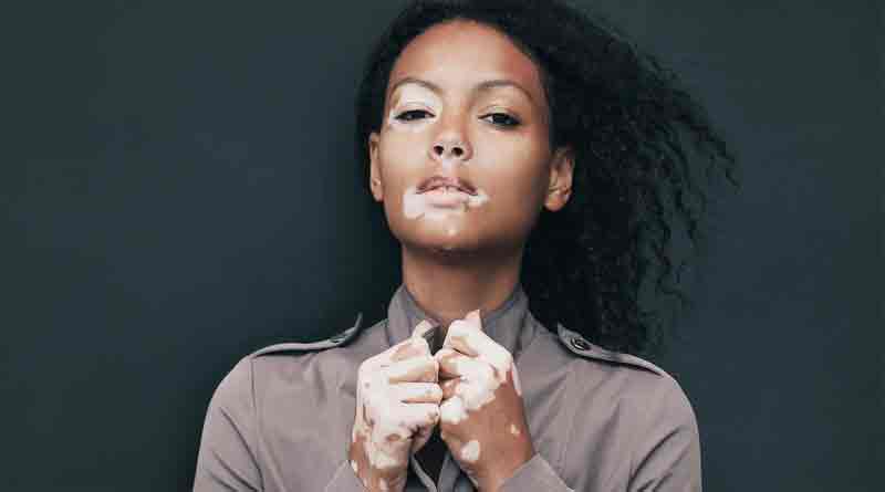 How to cure vitiligo