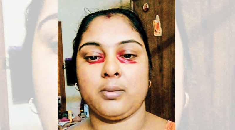 psychogenic purpura cured in SSKM