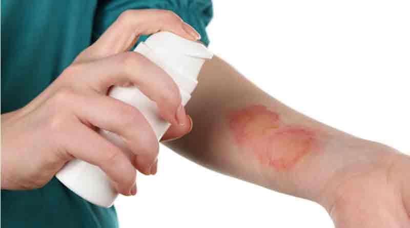 What to do on burn injury 