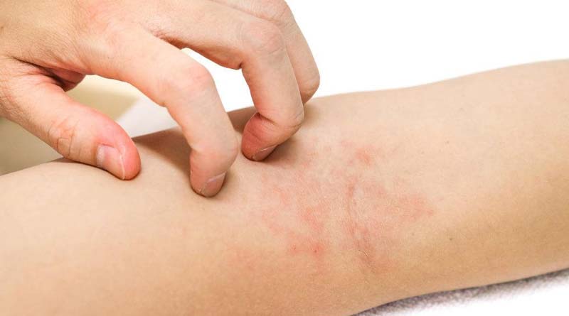 How to prevent allergy, specialists have some tips for you