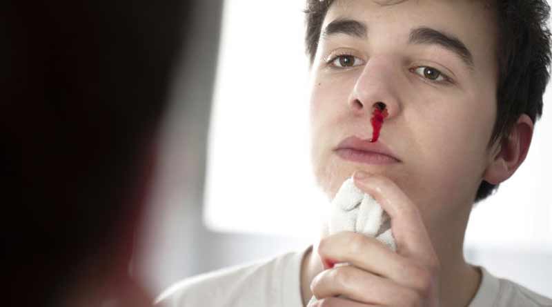 nose-bleeding