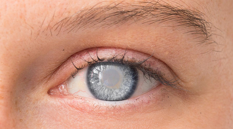 diabitic-eye