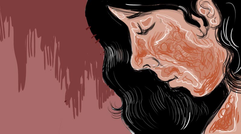 Husband allegedly throw acid on wife in Birbhum | Sangbad Pratidin