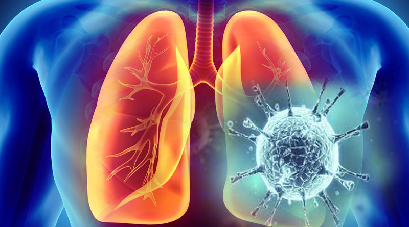 Asymptomatic corona patients can develop complications such as lung damage