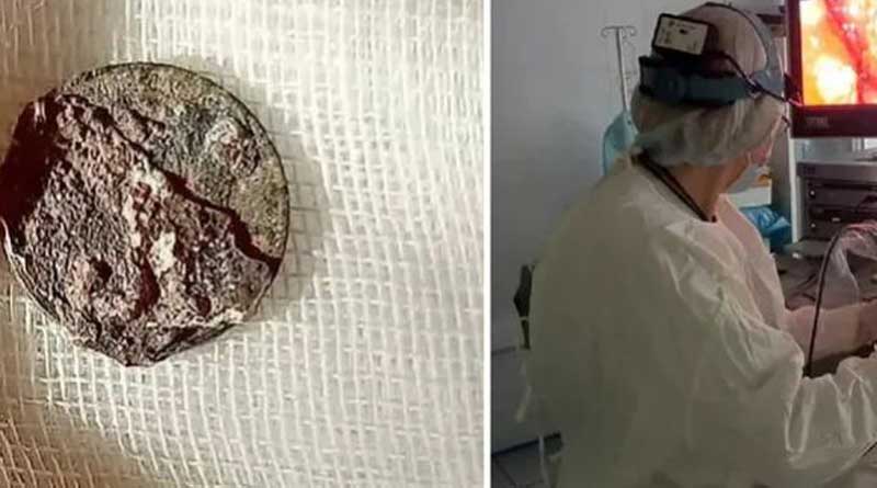Man has coin removed from his nose 50 years after he put it up his right nostril | Sangbad Pratidin