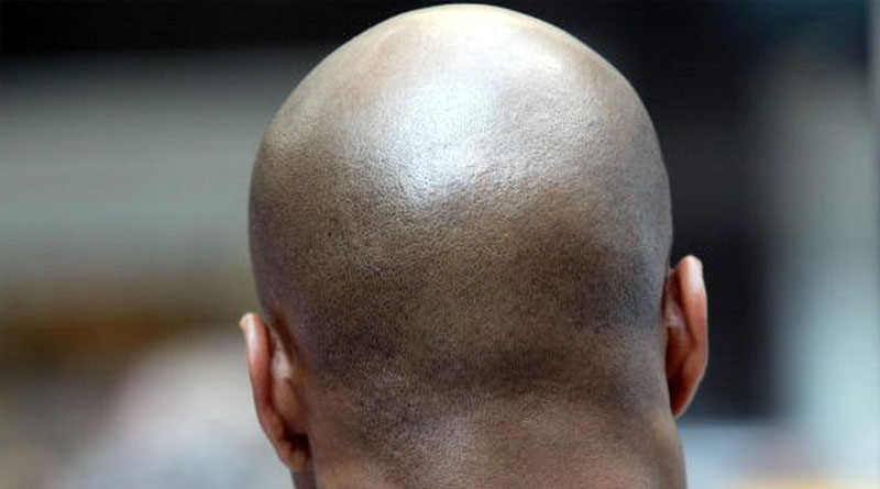 Calling someone bald at work is sexual harassment, rules employment tribunal has | Sangbad Pratidin