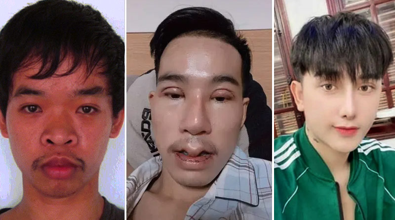 Man undergoes plastic surgery after he was laughed at for his looks during job interview | Sangbad Pratidin