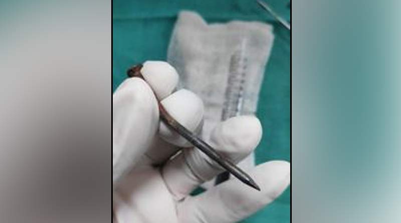 SSKM hospital perform rare surgery on sunday to save a child