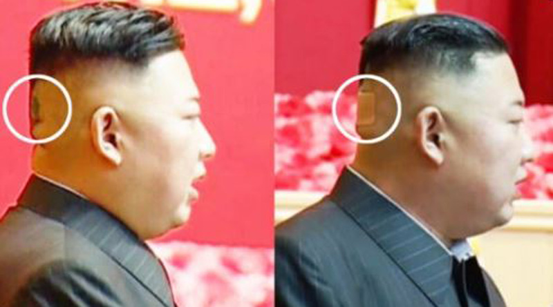 Bandage on back of North Korean dictator Kim Jong Un's head fuels rumours। Sangbad Pratidin