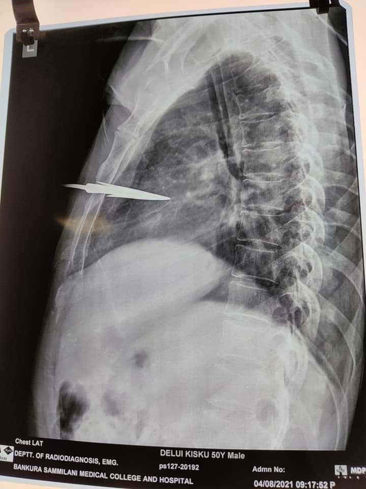 SSKM hospital gives arrow struck elderly man new life
