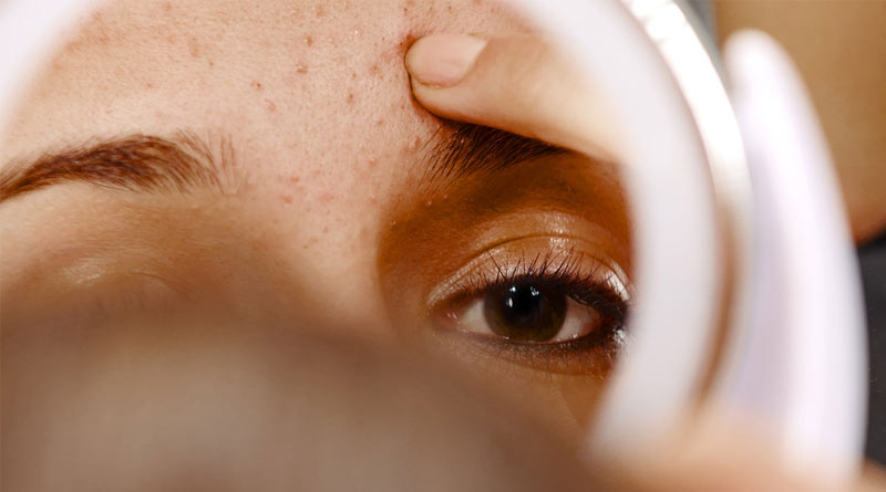 Skin Care Tips: How to avoid pimple during periods