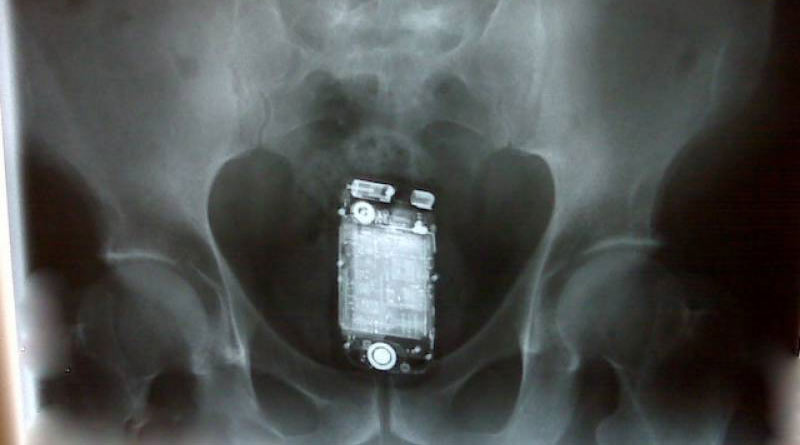 Man swallowed Mobile phone six months ago, removed after surgery | Sangbad Pratidin