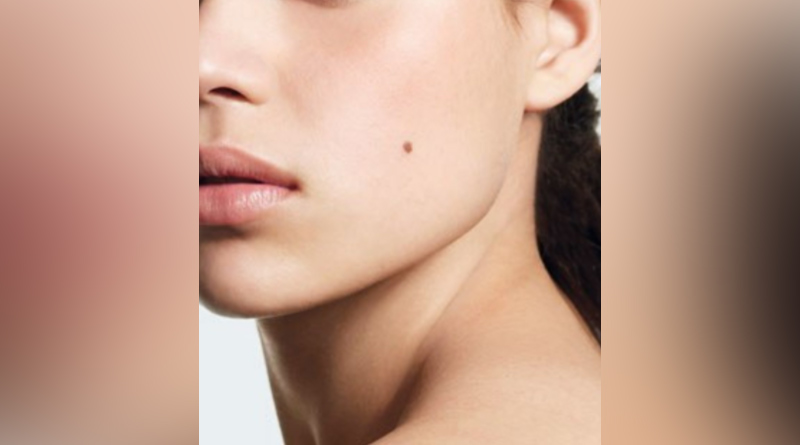 How to Cure Mole in Face, what experts says? | Sangbad Pratidin