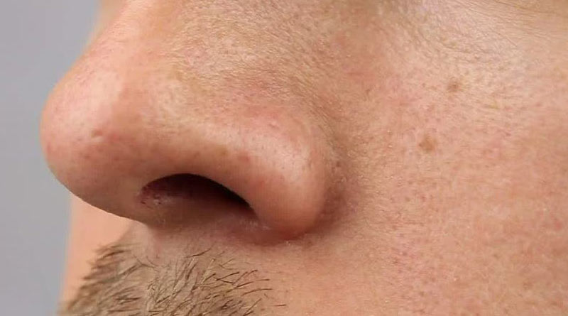 Strange growth of teeth inside the nose, caused breathing problem