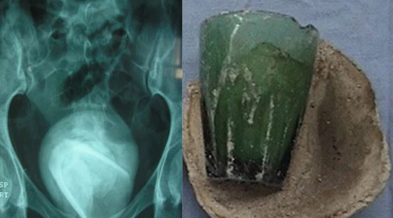 A glass found in the bladder of a Tunisian woman। Sangbad Pratidin