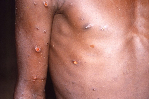 Monkeypox