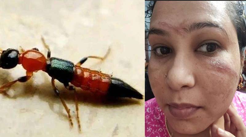 Acid bug sparks panic in Siliguri, skin burnt after it bites | Sangbad Pratidin