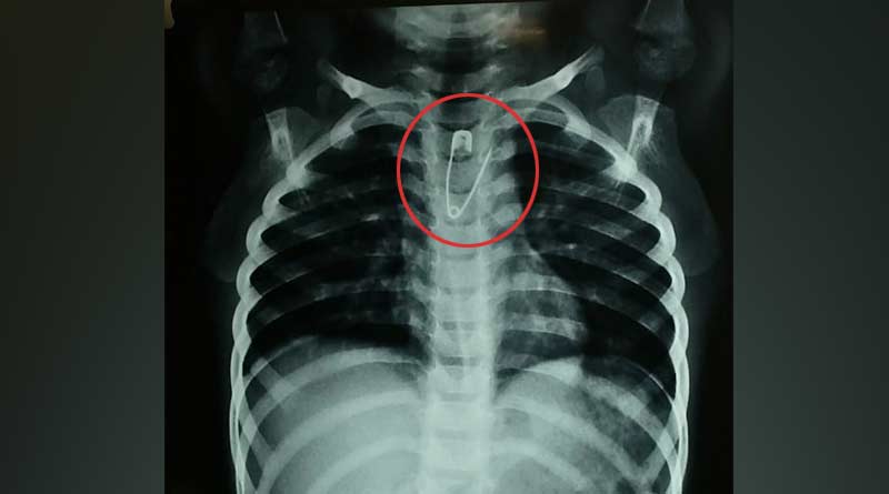 Doctor's of Diamond Harbour medical college successfully operates a rare surgery