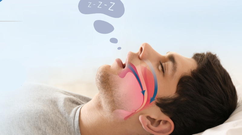 obstructive-sleep
