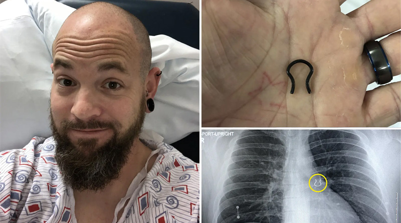 Doctors find nose ring in man's Lung lost it 5 years ago | Sangbad Pratidin
