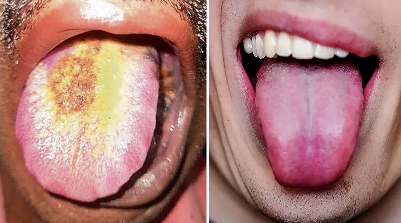 Important information by Eminent Doctor about Hairy Tongue | Sangbad Pratidin