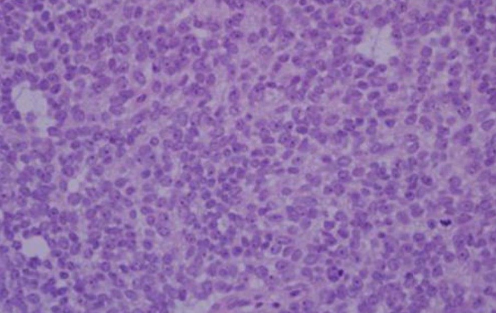 Ewing Sarcoma