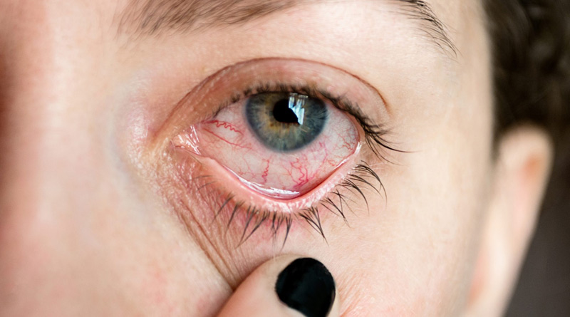Uveitis-in-eye-1