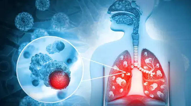 know the major cause of this deadly diseas Lung Cancer | Sangbad Pratidin