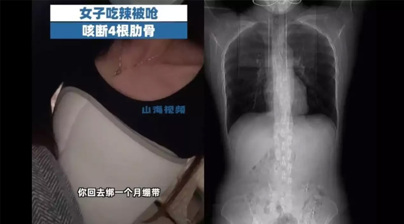 China Woman fractures 4 ribs while coughing after eating spicy food | Sangbad Pratidin