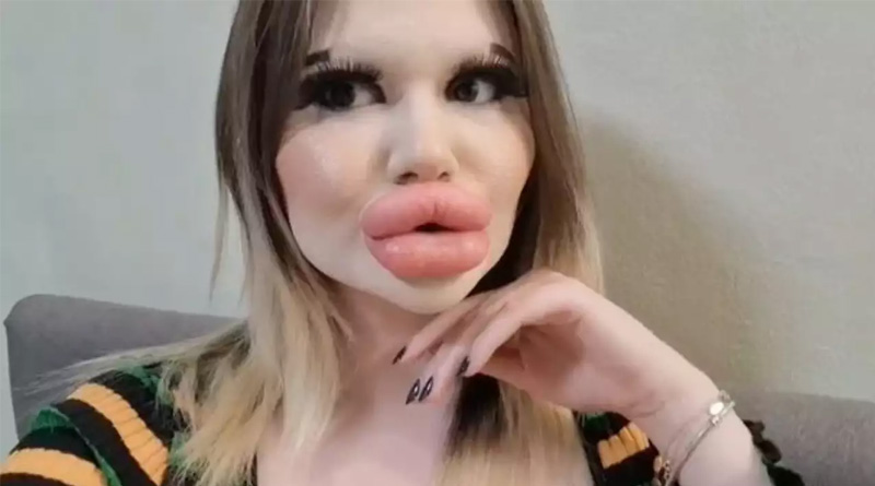 Woman with 'world's biggest lips' now wants huge cheekbones too | Sangbad Pratidin