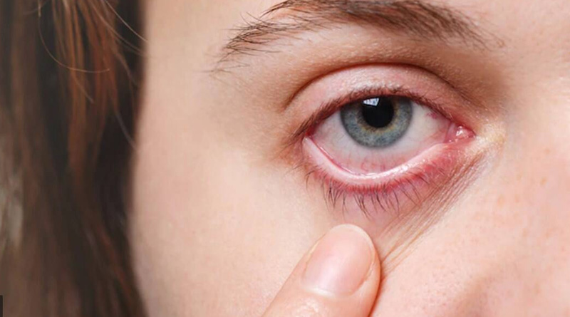 Eye