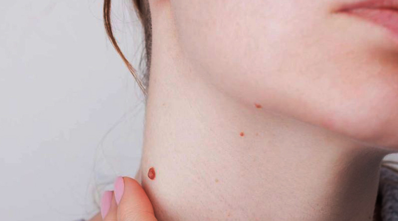 Moles-1