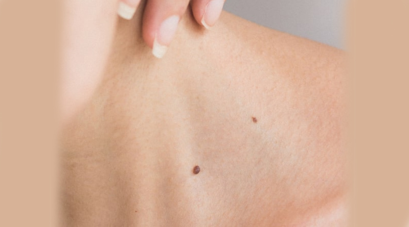Moles-2