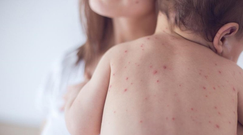 Scrub-Typhus-in-child-1