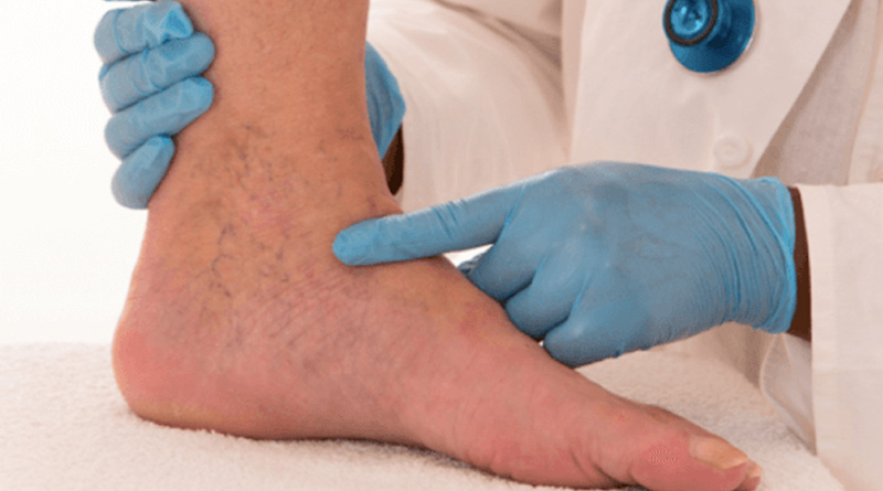 Leg-Ulcer-1