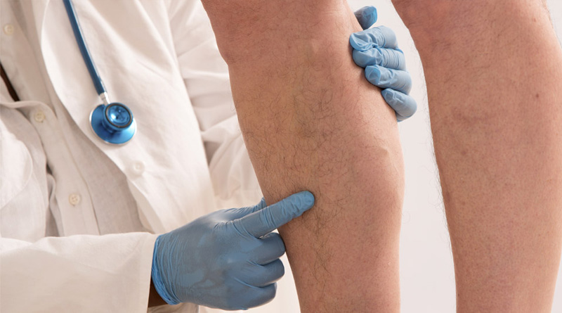 Leg-Ulcer-2