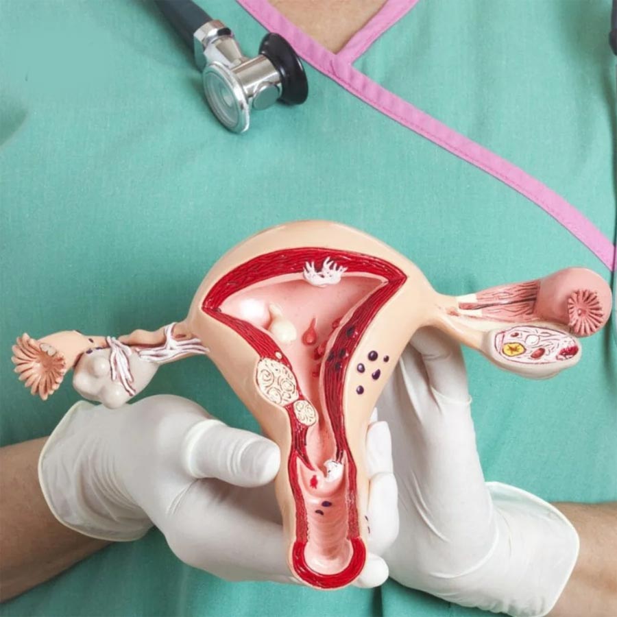 Cervical-Cancer-1